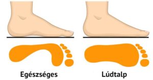 Lúdtalp kezelése masszázzsal 2 MassageAddict